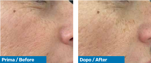 Před a PO nucleoNox